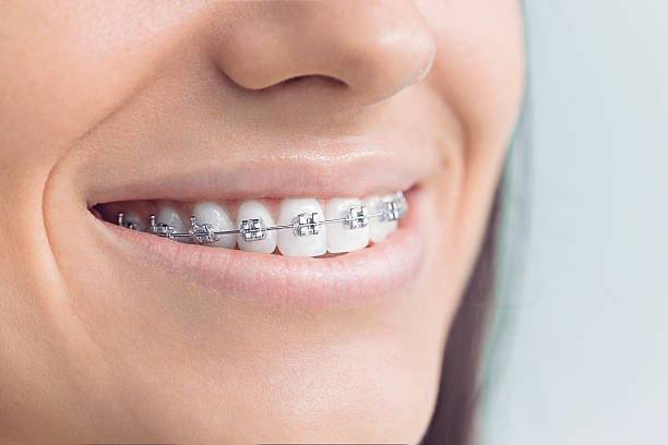 Best Traditional Braces  in Palm Harbor, FL